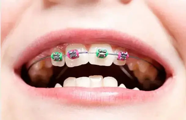 pink and green braces