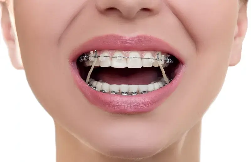 clear braces with rubber bands